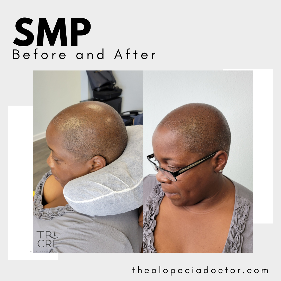 Before and After picures of SMP customer with scarring alopecia.