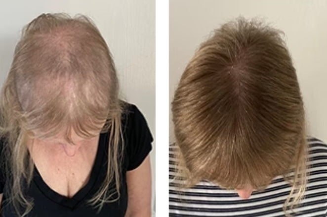 Hair Loss Recovery Kit 7-Week Protocol