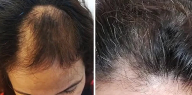 Hair Loss Recovery Kit 7-Week Protocol