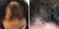Hair Loss Recovery Kit 7-Week Protocol
