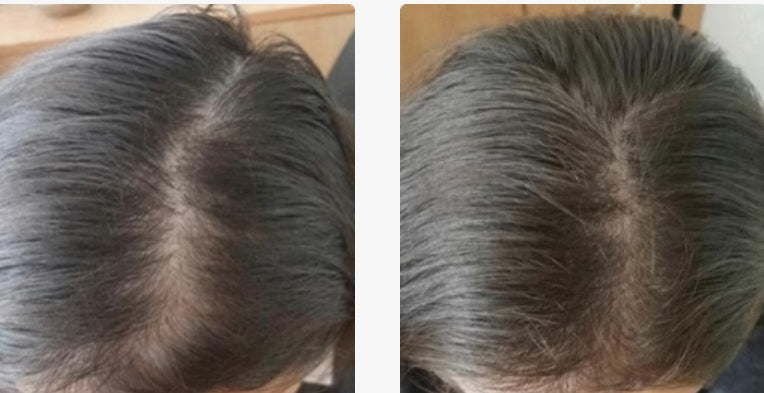 Hair Loss Recovery Kit 7-Week Protocol