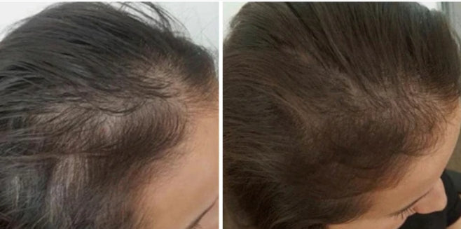 Hair Loss Recovery Kit 7-Week Protocol