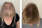 Hair Loss Recovery Kit 7-Week Protocol